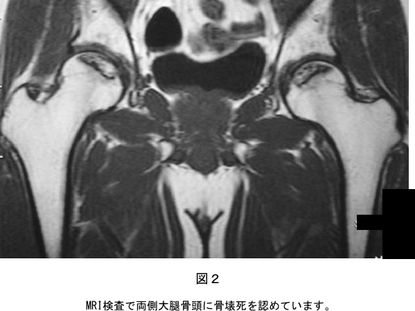 　図２.　MRI検査で両側大腿骨頭に骨壊死を認めています。画像