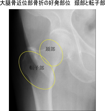 ヒップジョイントコラム29　大腿骨近位部骨折の好発部位　頚部と転子部　画像