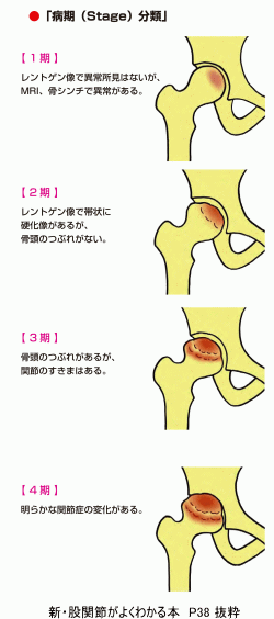 特発性大腿骨頭壊死症　病期（Stage）分類　画像
